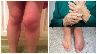 the effects of osteoarthritis