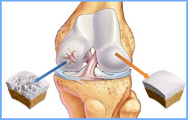 Normal knee joint affected by osteoarthritis. 