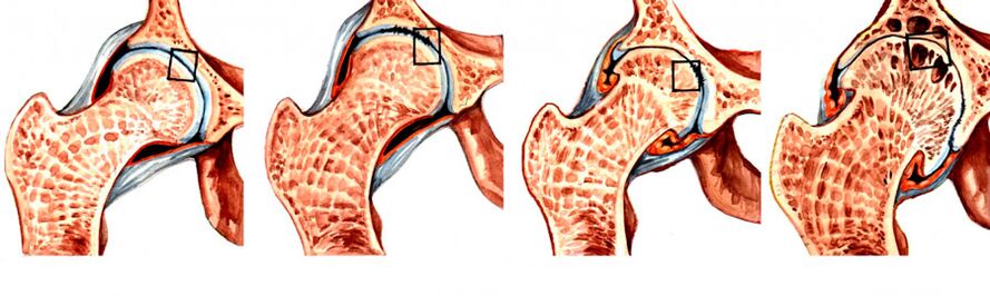 The degree of development of coxarthrosis of the hip joint. 