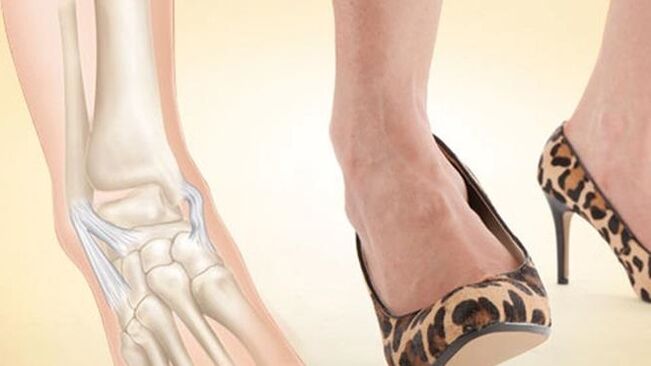 the use of shoes with heels as a cause of ankle osteoarthritis
