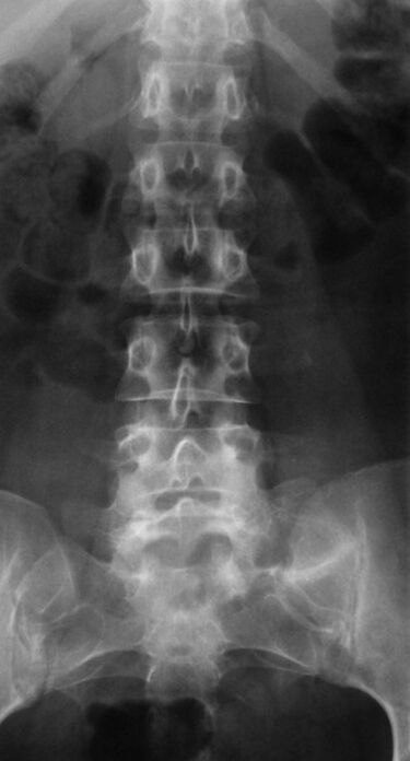 To diagnose lumbar osteochondrosis, an x-ray is performed. 