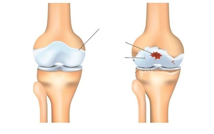 Healthy and patient with arthrosis articulations