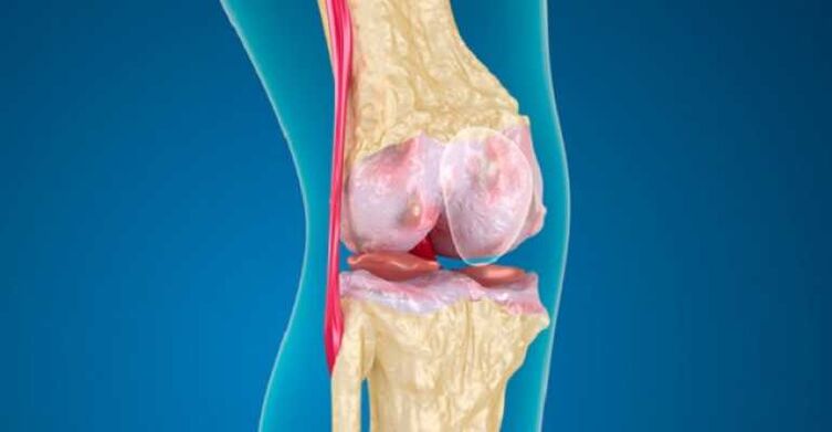 Osteoarthritis of the knee joint disease, which causes the destruction of the cartilage in the joints
