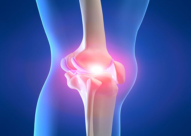 Joint pain due to knee osteoarthritis.