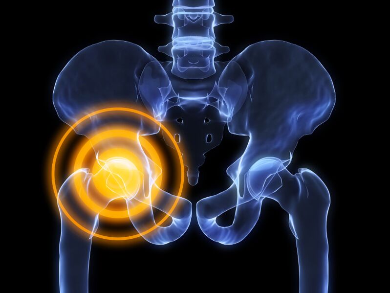 osteoarthritis of the hip joint