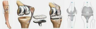 The total knee replacement in the example of the tribe of