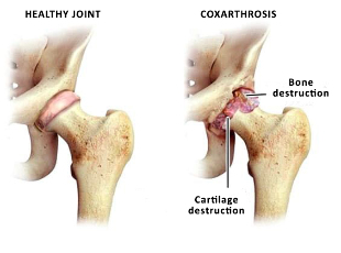 comparison healthy joint and zustavas dysplastic